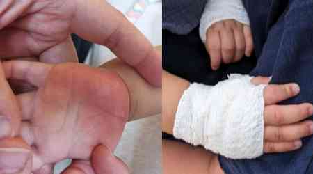 Mum accuses preschool of negligence after 11-month-old boy burns hands on hot surface