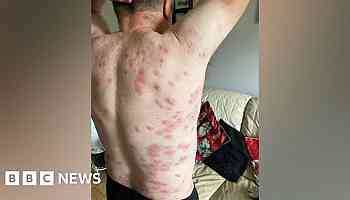 Victim of 250 wasp stings fears going outside