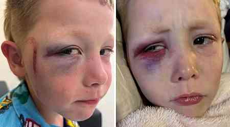 5yo bashed with golf club by another child