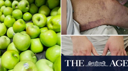 Man diagnosed with scurvy amid cost-of-living crisis