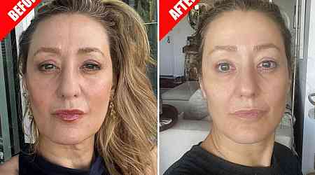 The hot new trend? A non-surgical facelift with no downtime