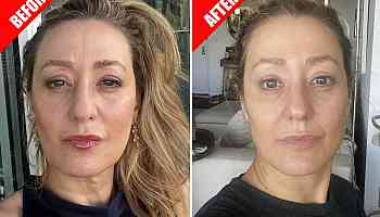 The hot new trend? A non-surgical facelift with no downtime