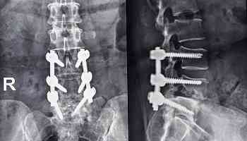 Luigi Mangione Said He Had Spondylolisthesis: What Is It?