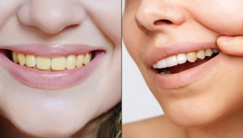 Major mistake people make to get yellow teeth even if they brush them twice a day