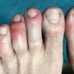 Are COVID Toes and Rashes Common Symptoms of the Coronavirus?