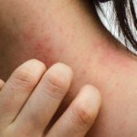 How Lifestyle Changes and Self-Care Can Improve Your Atopic Dermatitis