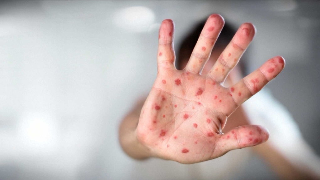 Ontario's top doctor warns of 'potential outbreaks' of measles