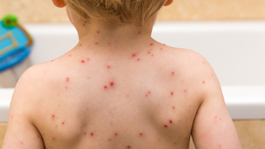 Daycare provider ordered to refund B.C. parents after chickenpox party dispute