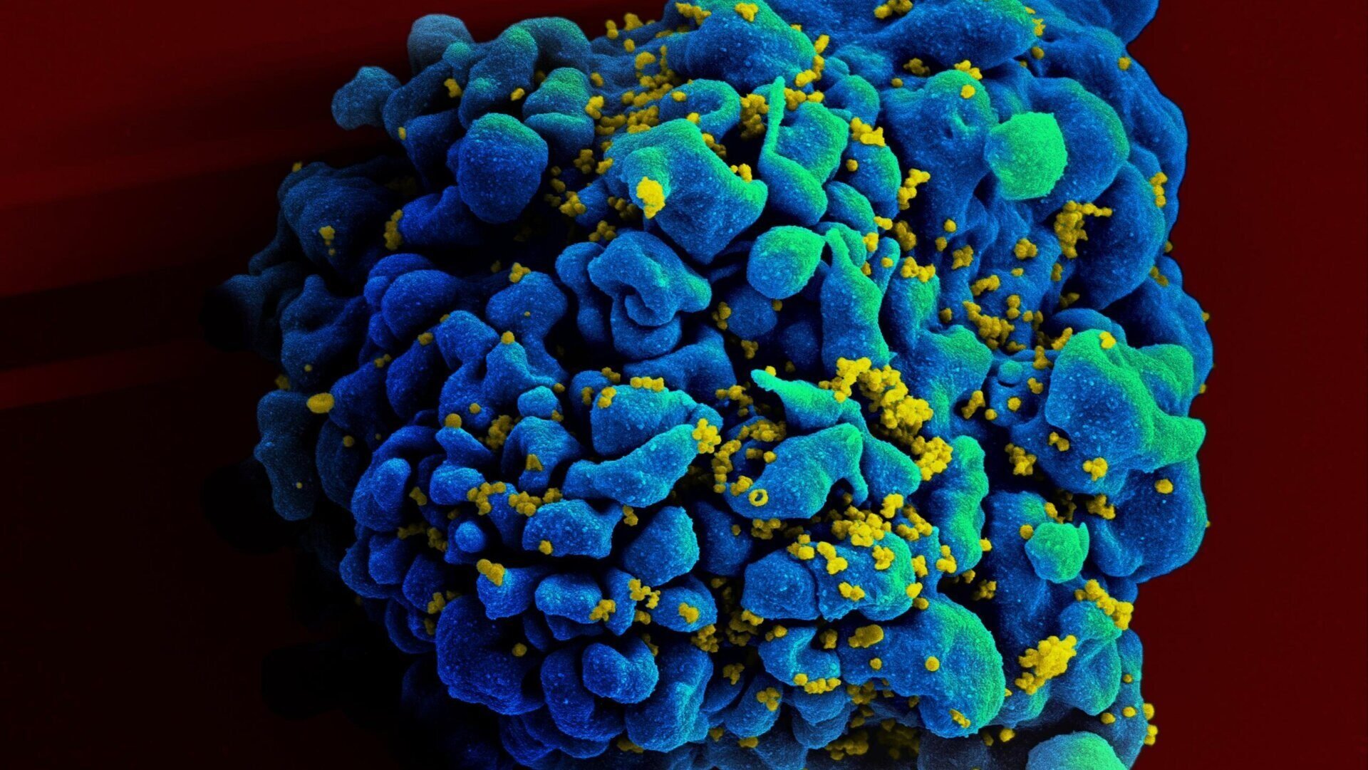 Latest HIV Cure Case Is the Most Encouraging One Yet