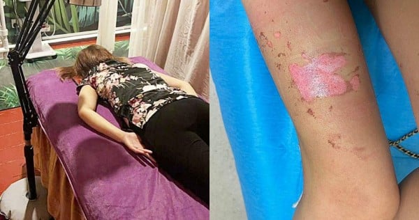 'It nearly killed me': Woman suffers burns from TCM treatment, Bugis massage parlour says it was not negligent