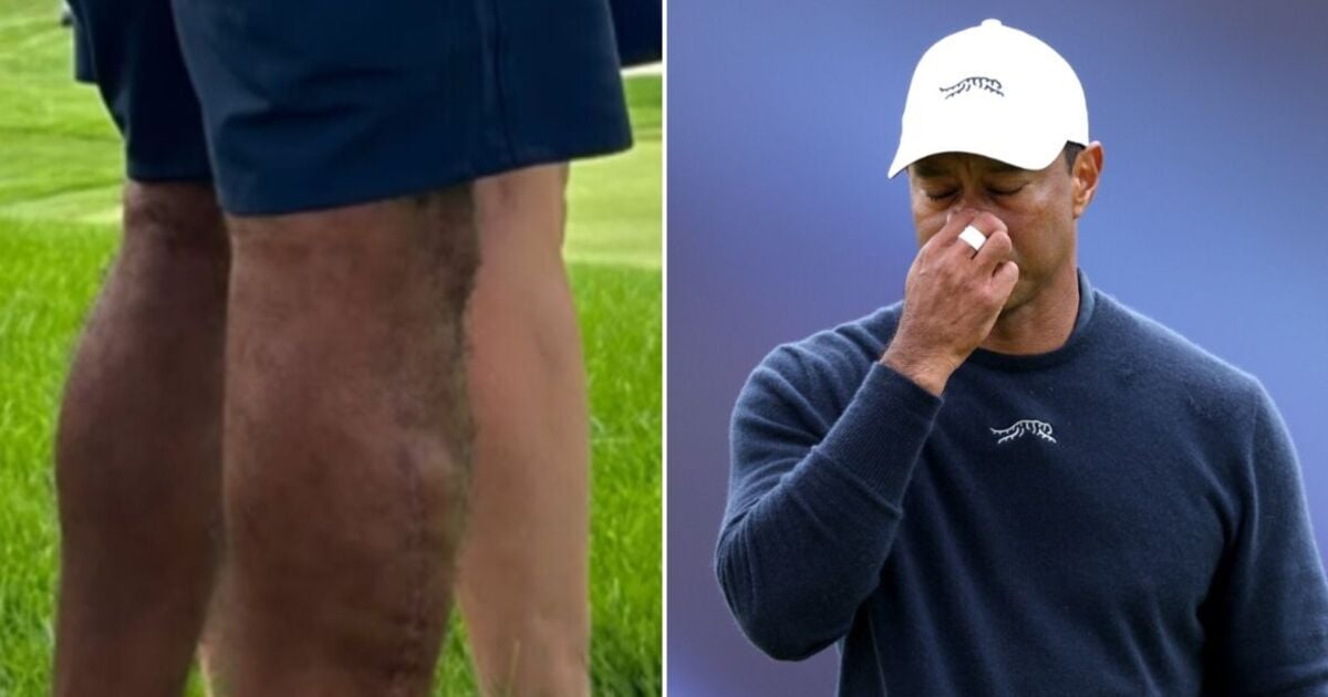 New photo of Tiger Woods' uncovered leg shows full extent of brutal surgery