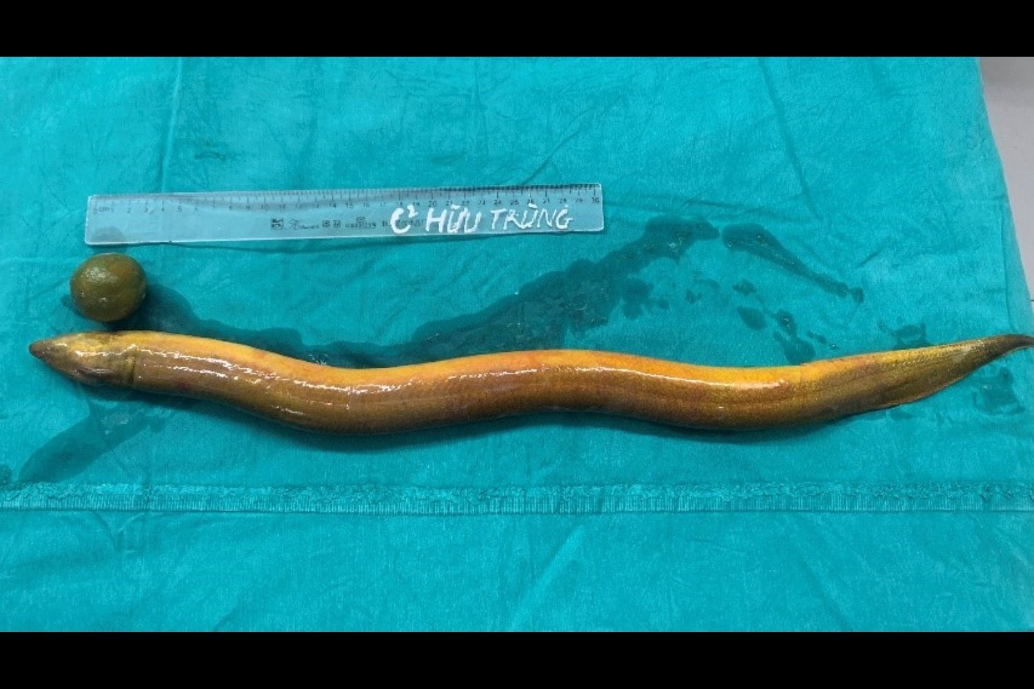 Man Sticks 2-Foot Eel up His Butt, Gets Surgery After Eel Starts Chewing Through Intestines