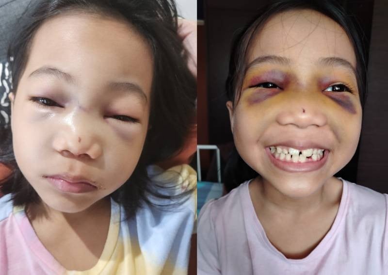 7-year-old suffers bruising on face after allegedly getting flung out of seat on school bus