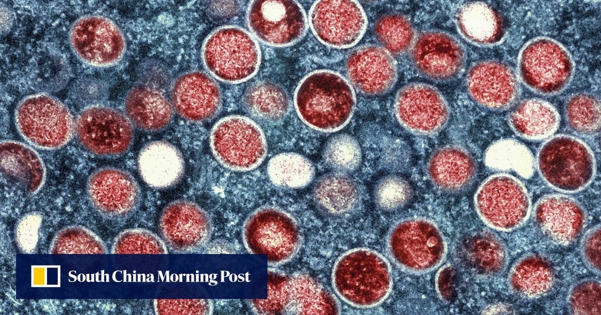 Hong Kong at risk of mpox outbreak as population has low immunity, experts say