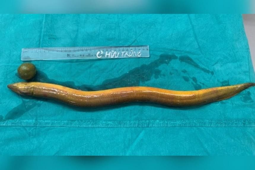 Man in Vietnam inserts live eel up his rear, punctures colon... and survives
