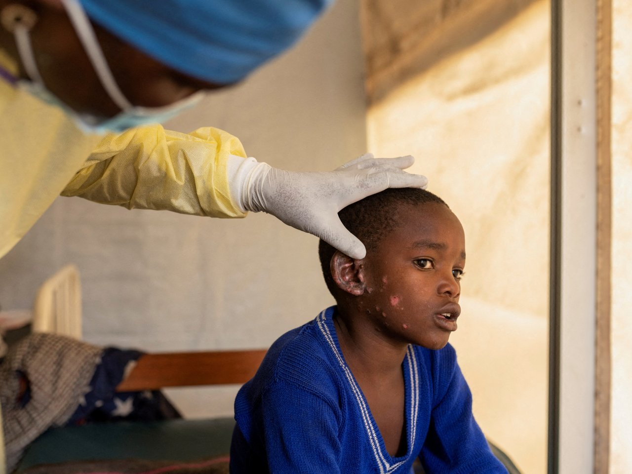 Mpox killed 548 people in DR Congo since start of 2024