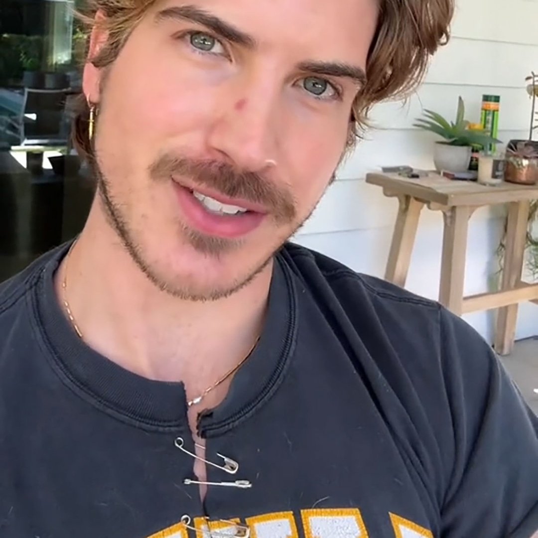  YouTuber Joey Graceffa Shares Skin Cancer Diagnosis 