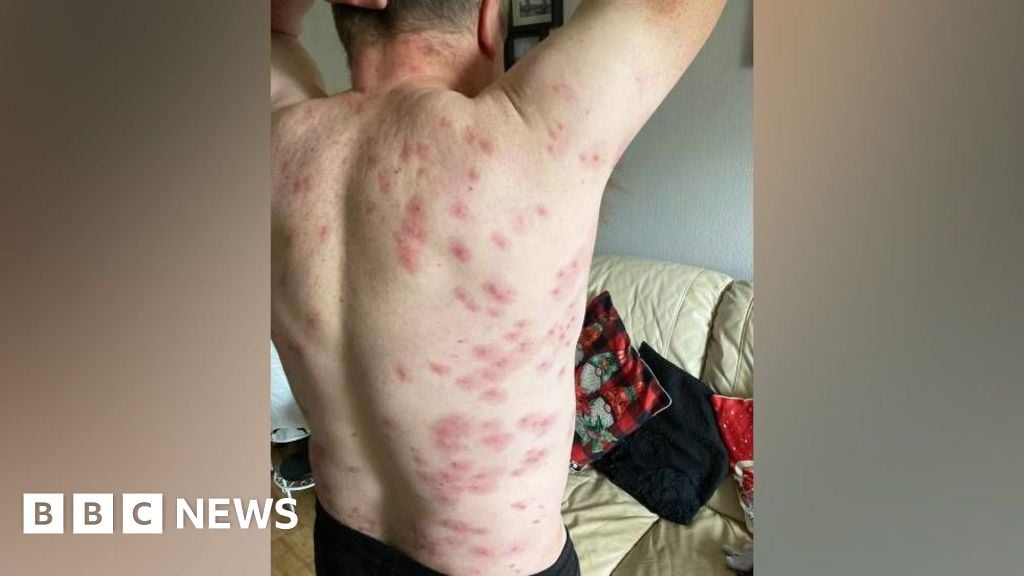 Victim of 250 wasp stings fears going outside