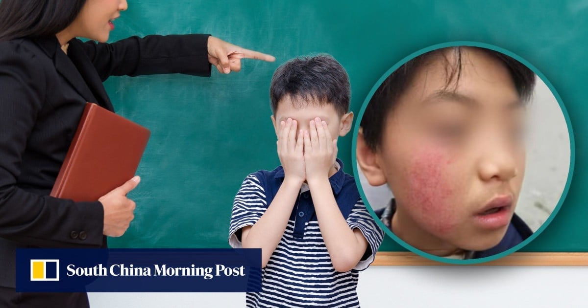 Mother in China claims son suffers skin pigmentation loss after being slapped by teacher