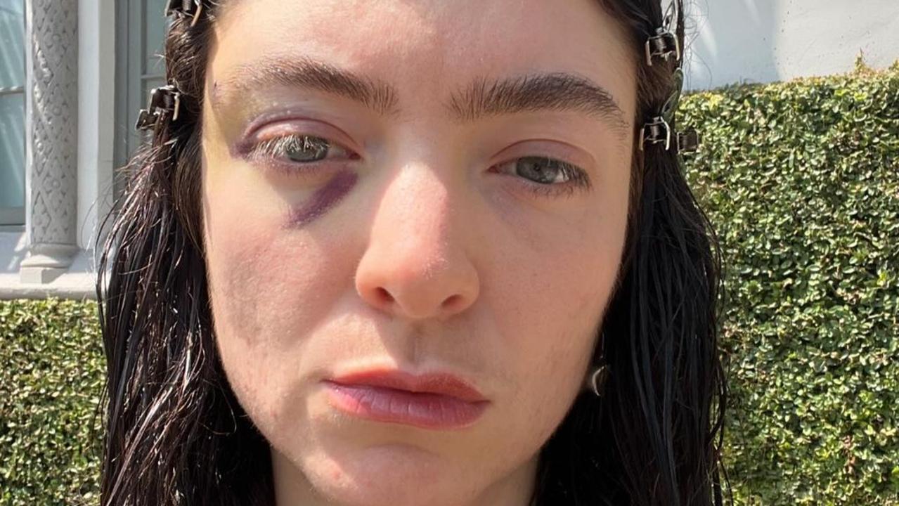 Lorde worries fans with cryptic photos