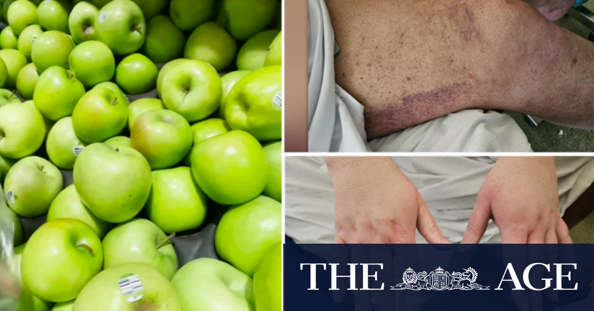 Man diagnosed with scurvy amid cost-of-living crisis