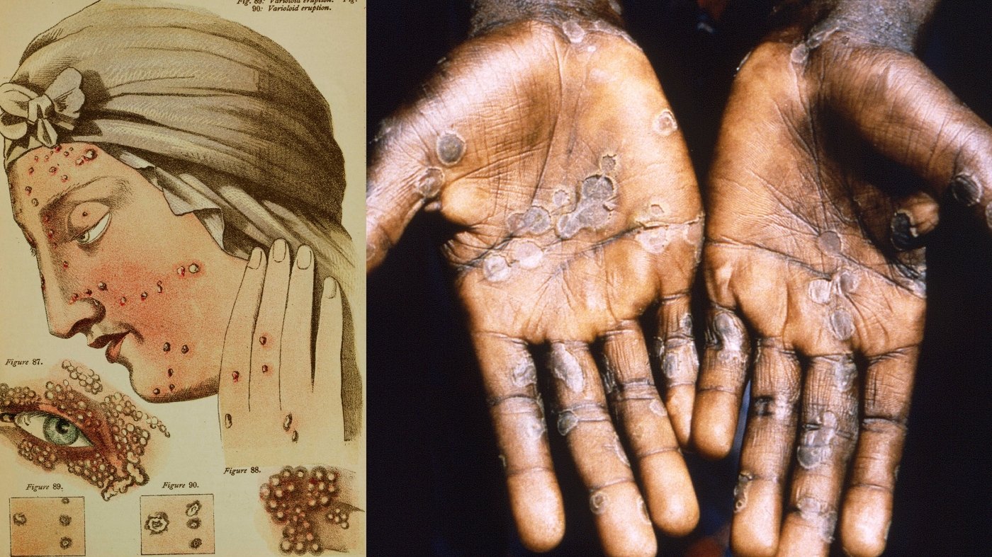 The end of smallpox was ... the beginning for mpox