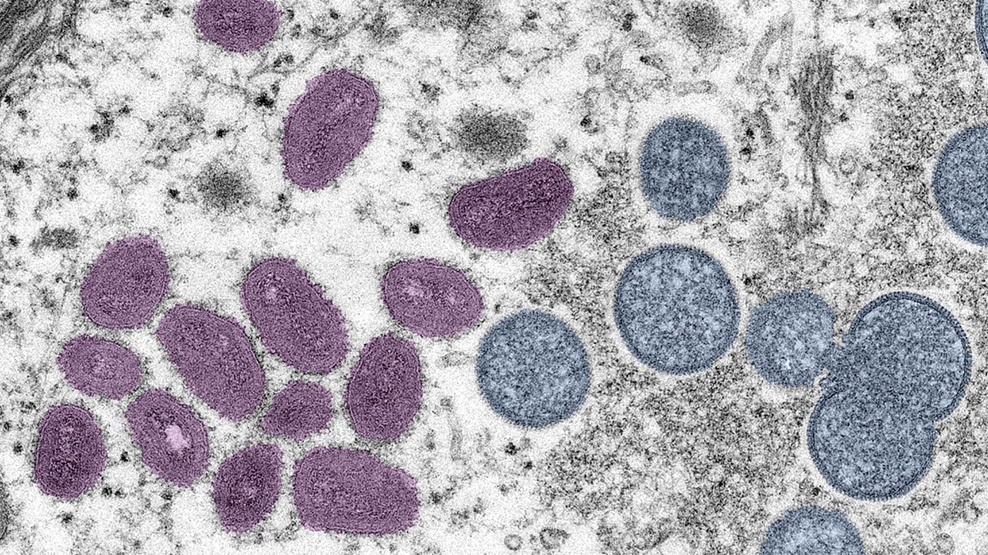 A more severe strain of mpox has been detected in the U.S. for the first time