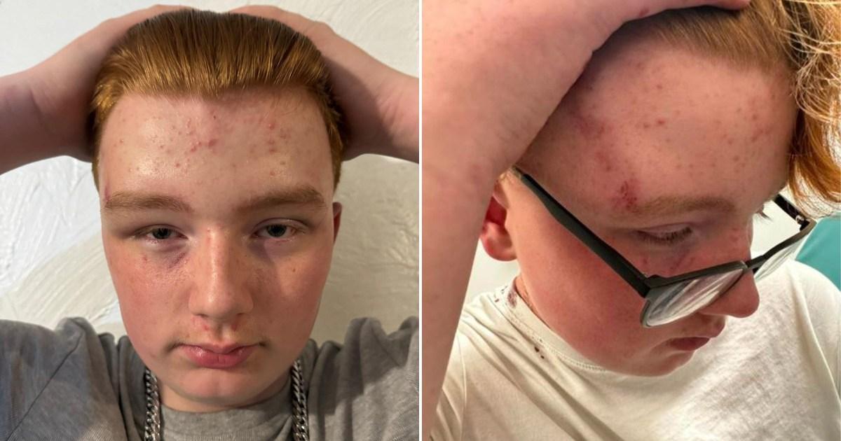 Autistic boy, 14, stabbed in head by teens who also tried to set him on fire