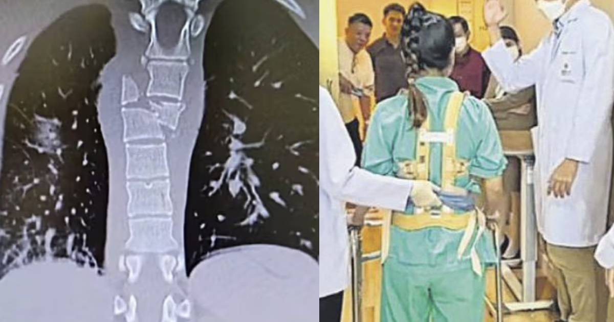 SQ321 turbulence: Malaysian woman, 23, walks again after suffering fractured spine