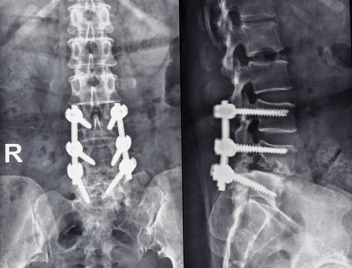 Luigi Mangione Said He Had Spondylolisthesis: What Is It?