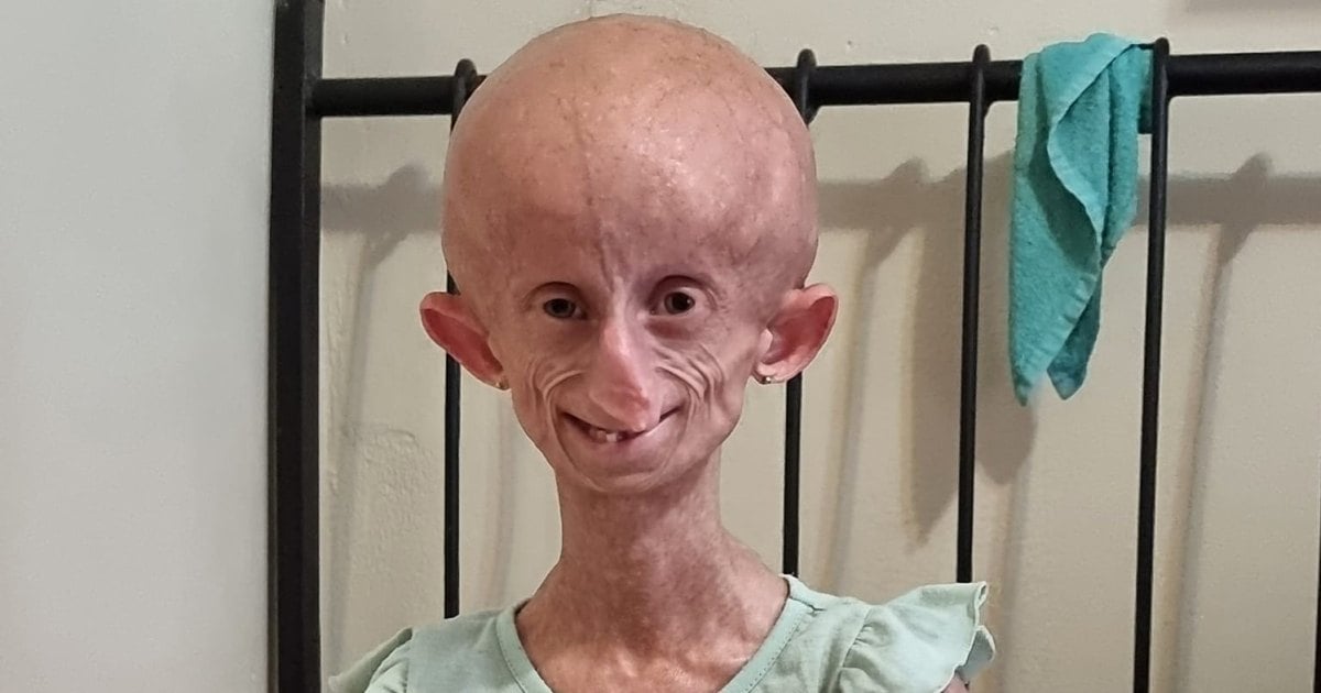 TikTok Star Beandri Booysen Dies at 19 From Rare Aging Disease