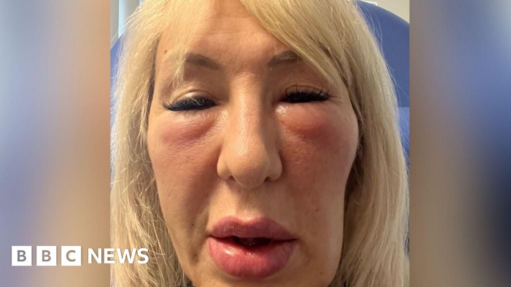 'I paid fake doctor thousands for fillers - now I look like a gargoyle'