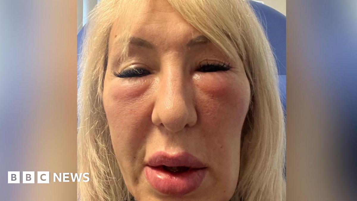 Botched fillers left Hull woman 'looking like a gargoyle'